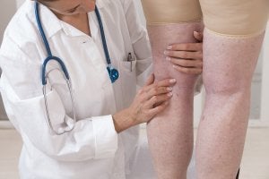 Spider Vein Treatment Spider Vein Treatment in Rockville Centre